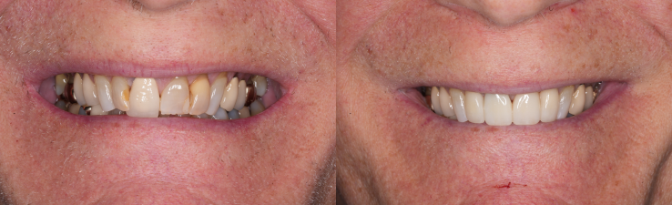 Side-by-side comparison of before and after results highlighting dental treatment at Dental Partners of Creve Coeur.