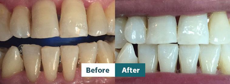 Before and after dental photos illustrating positive changes at Dental Partners of Creve Coeur under Dr. Singh’s care.