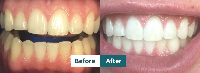 Before and after dental treatment showcasing a transformed smile at Dental Partners of Creve Coeur.