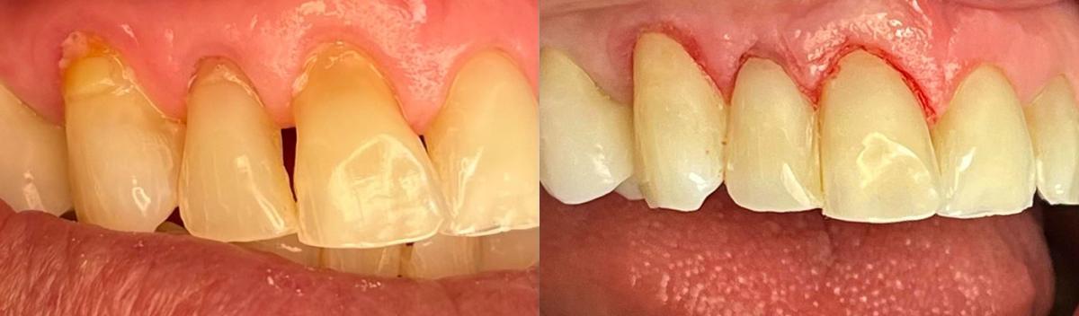 Visible dental improvement with before and after photos at Dental Partners of Creve Coeur, demonstrating effective treatment results.