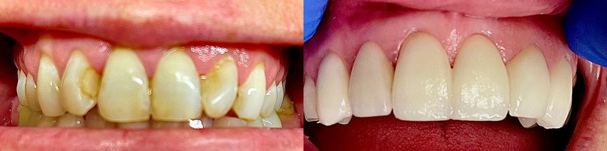 Side-by-side before and after images displaying enhanced dental health by Dr. Singh at Dental Partners of Creve Coeur.