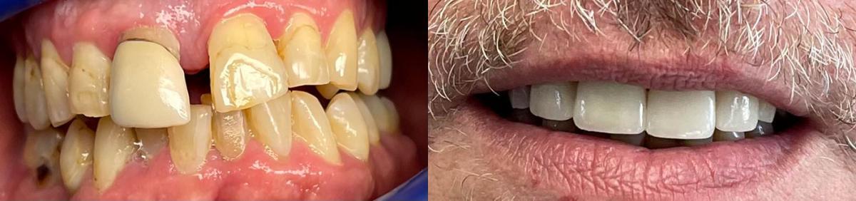 Significant dental transformation shown in before and after images at Dental Partners of Creve Coeur in St. Louis.